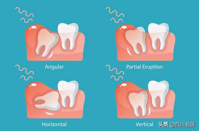 智齿要不要拔看完这篇我瞬间懂了（智齿到底要不要拔）(9)