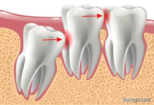 智齿要不要拔看完这篇我瞬间懂了（智齿到底要不要拔）(16)